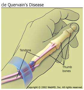 Описание: de_Quervains_arthritis_de_quervains_disease_information